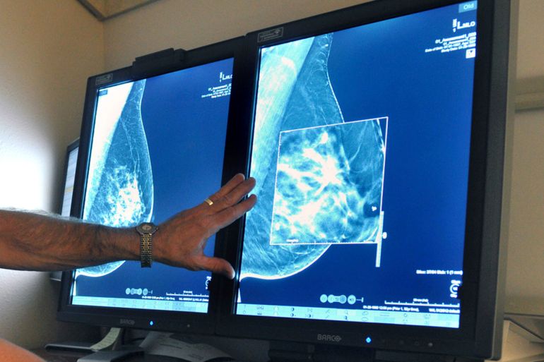Karcionom dojke, Rak dojke, Mamografija